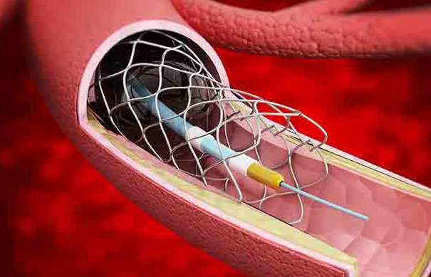 全國高值耗材集采靴子落地，百億冠脈支架市場(chǎng)將行業(yè)洗牌